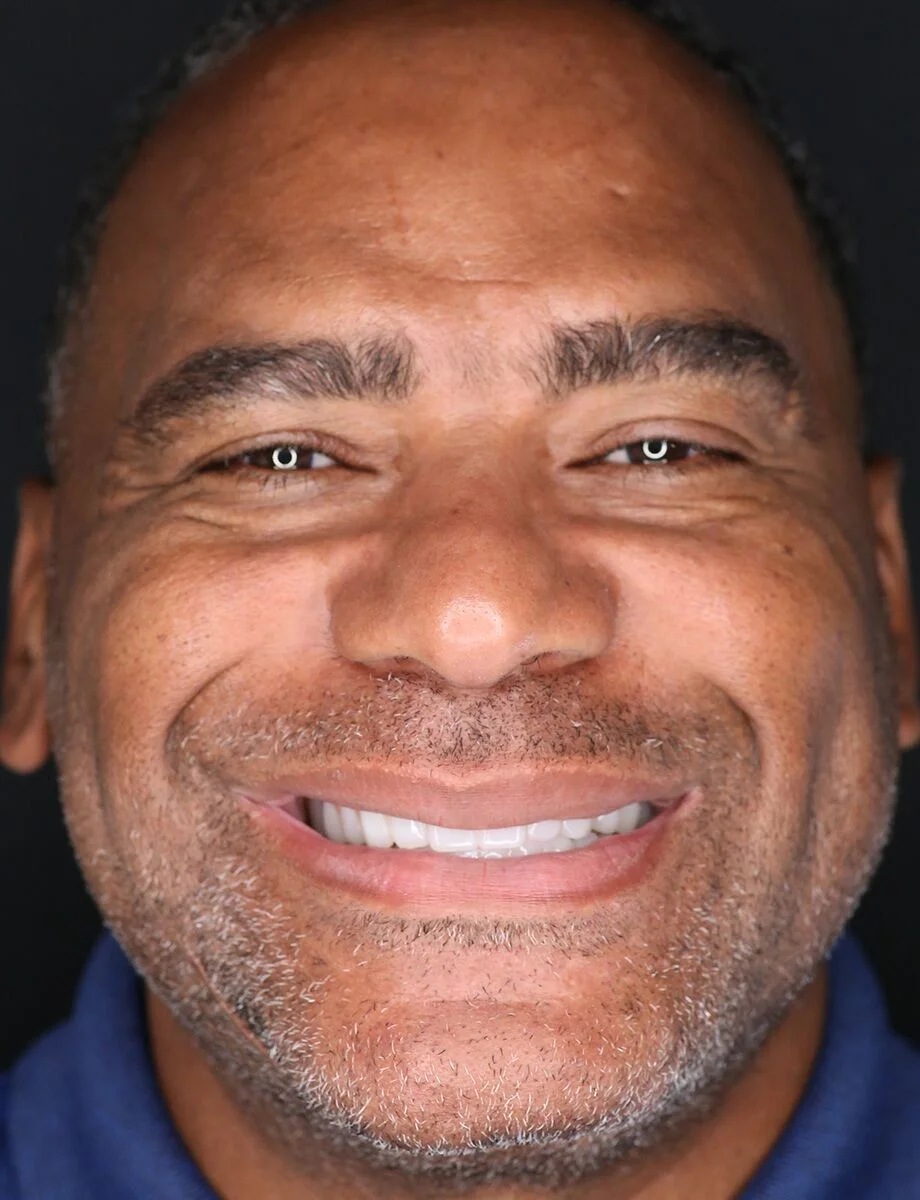 Full-arch transformation — Case 3 — after full-arch dental implants at Full Implant Choice