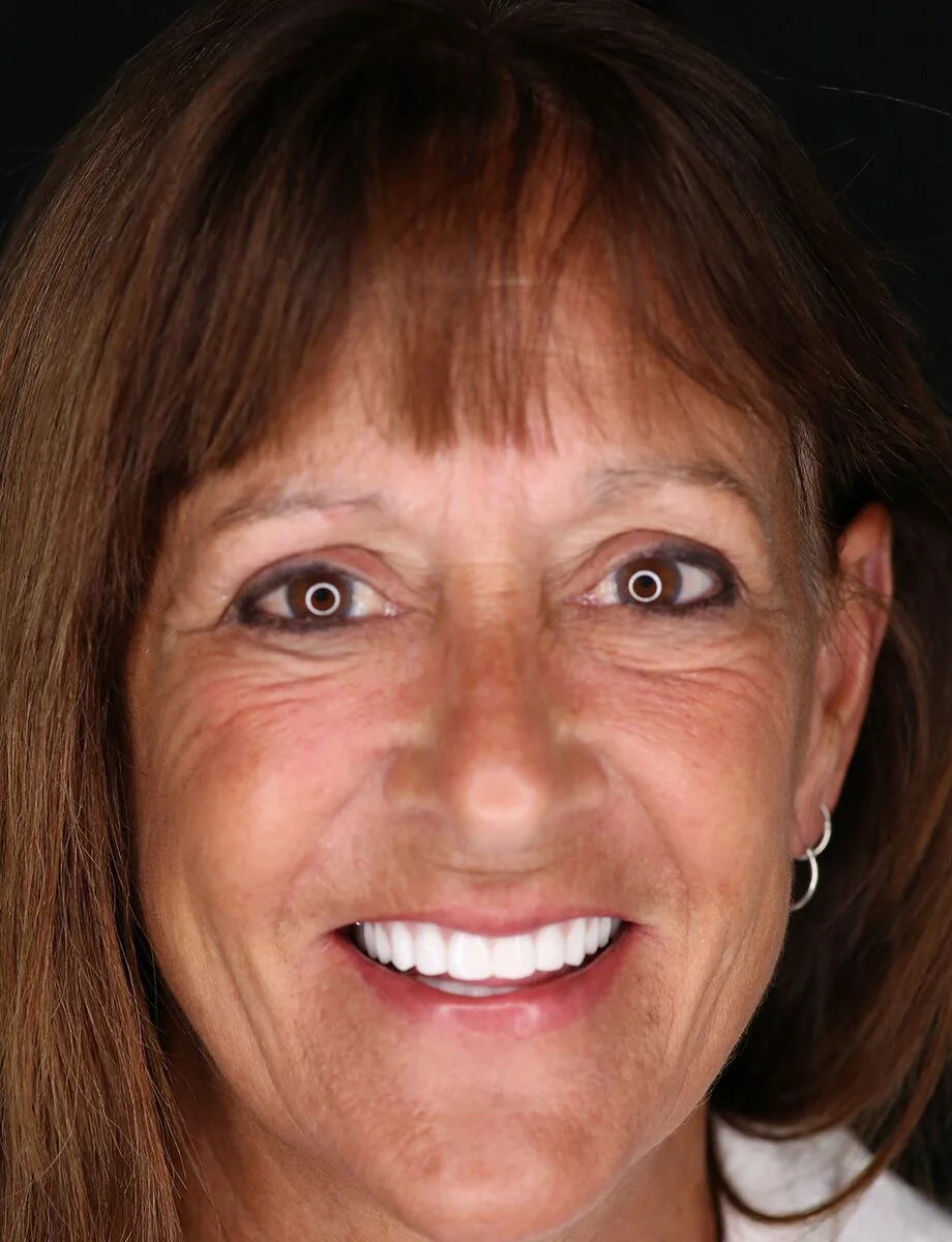 Full-arch restoration by Dr. Hogan — after full-arch dental implants at Full Implant Choice