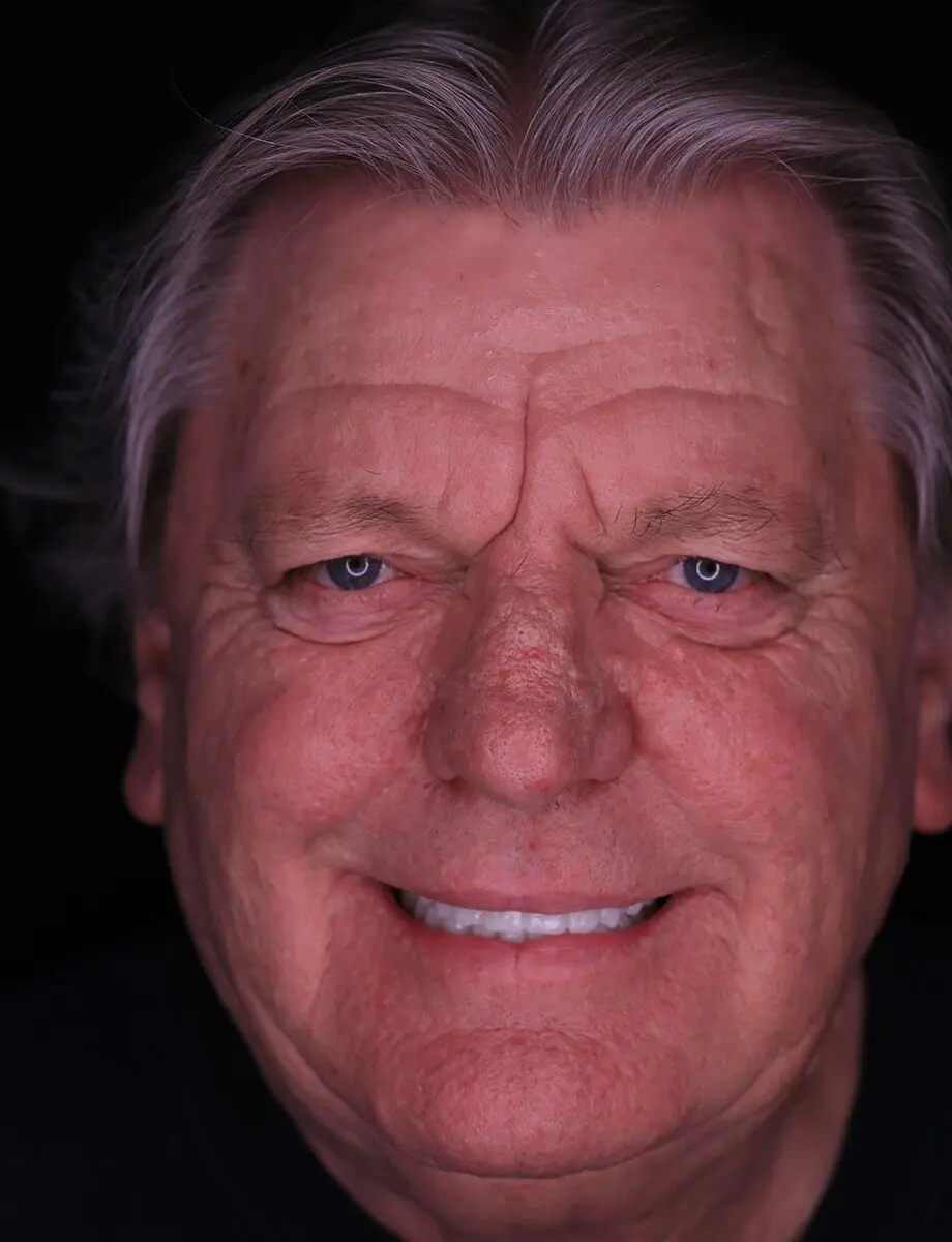 Full-arch reconstruction by Dr. Hogan — after full-arch dental implants at Full Implant Choice