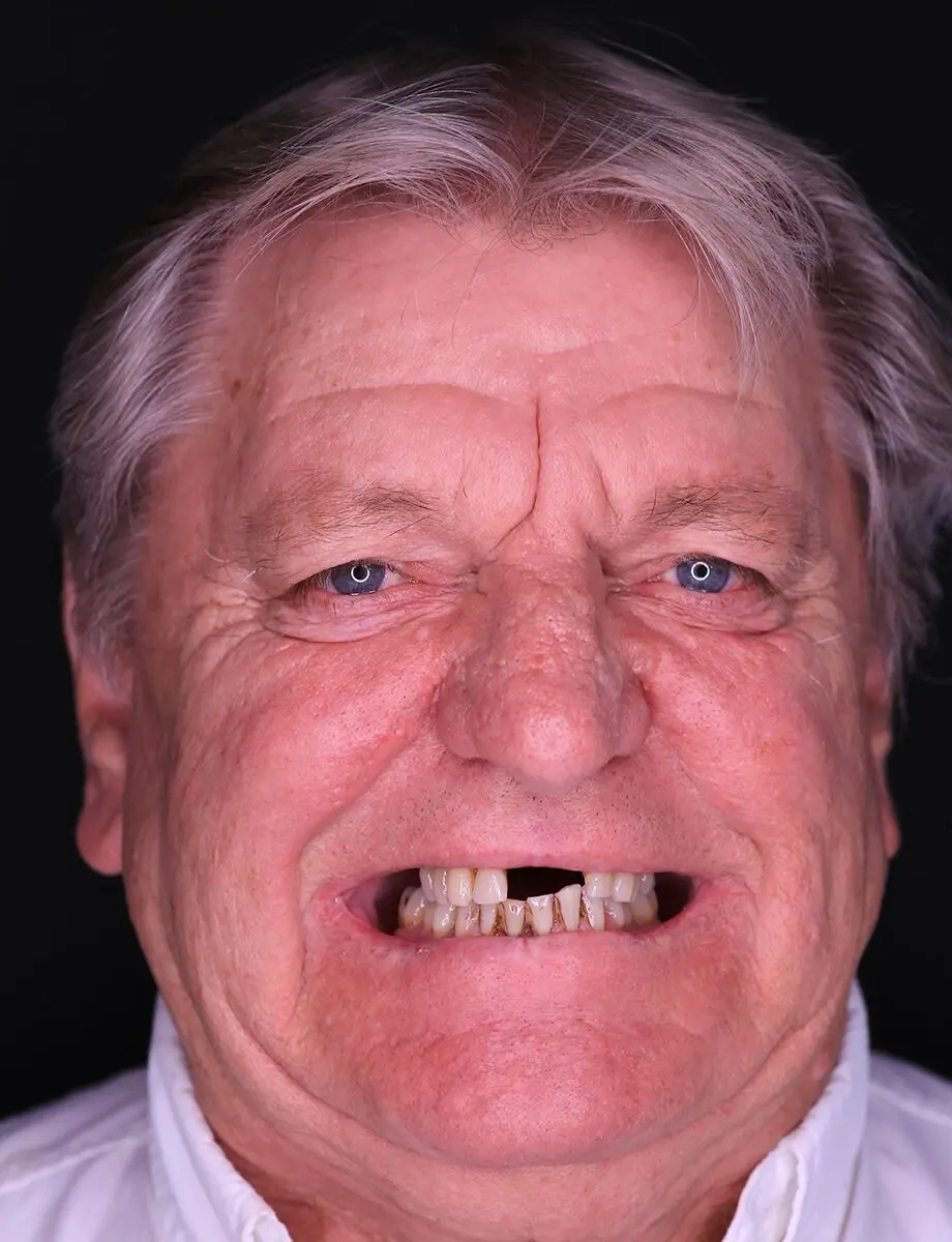 Full-arch reconstruction by Dr. Hogan — before treatment
