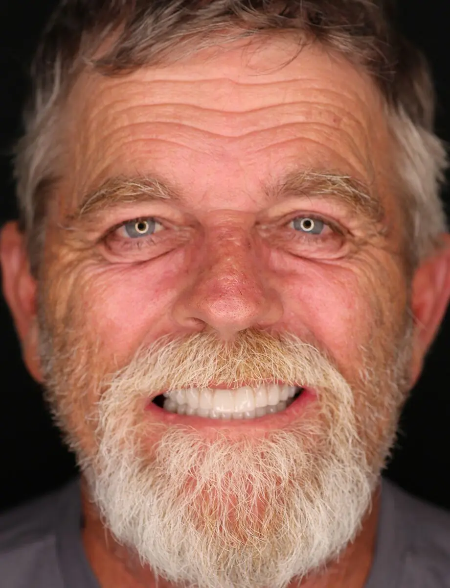 Full-arch transformation — Case 6 — after full-arch dental implants at Full Implant Choice