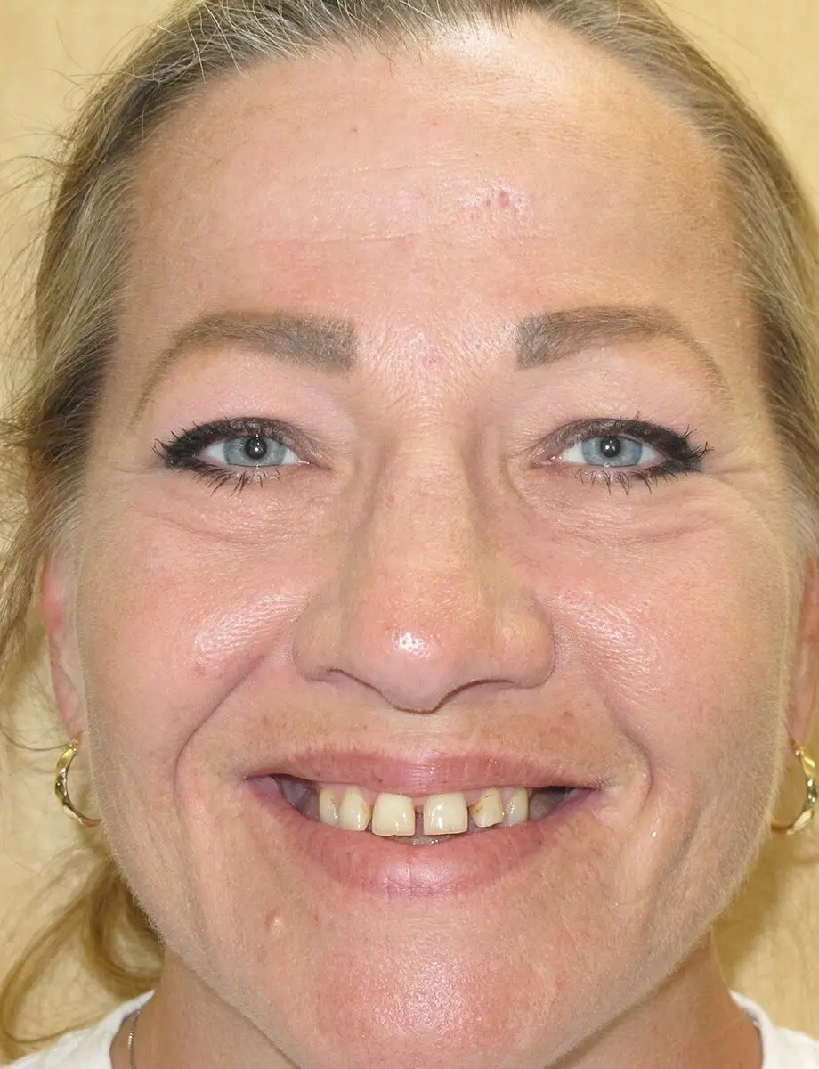 Full-arch transformation — Case 7 — before treatment